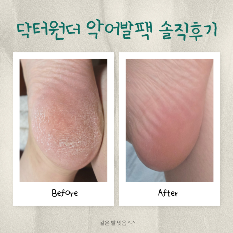 [닥터원더 악어발팩 내돈내산] 2달 된 솔직후기 & 사용 꿀팁 / 올리브영 풋케어 발 각질정리 ....