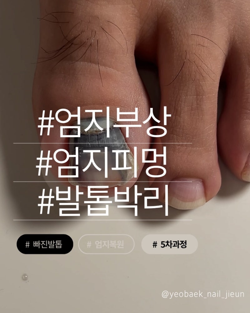 [하남/남양주 문제성발톱] 엄지발톱 피멍·박리부터 복원, 내성발톱 교정까지 5차 관리 후기