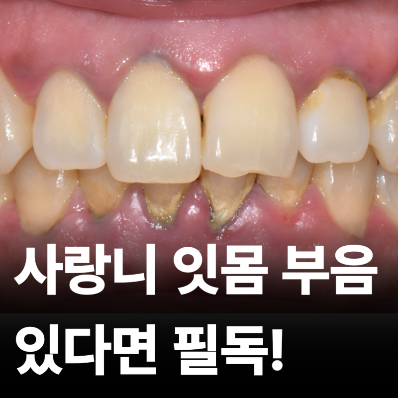 잇몸 부음 원인 어금니 사랑니 위치별로 다른 이유?