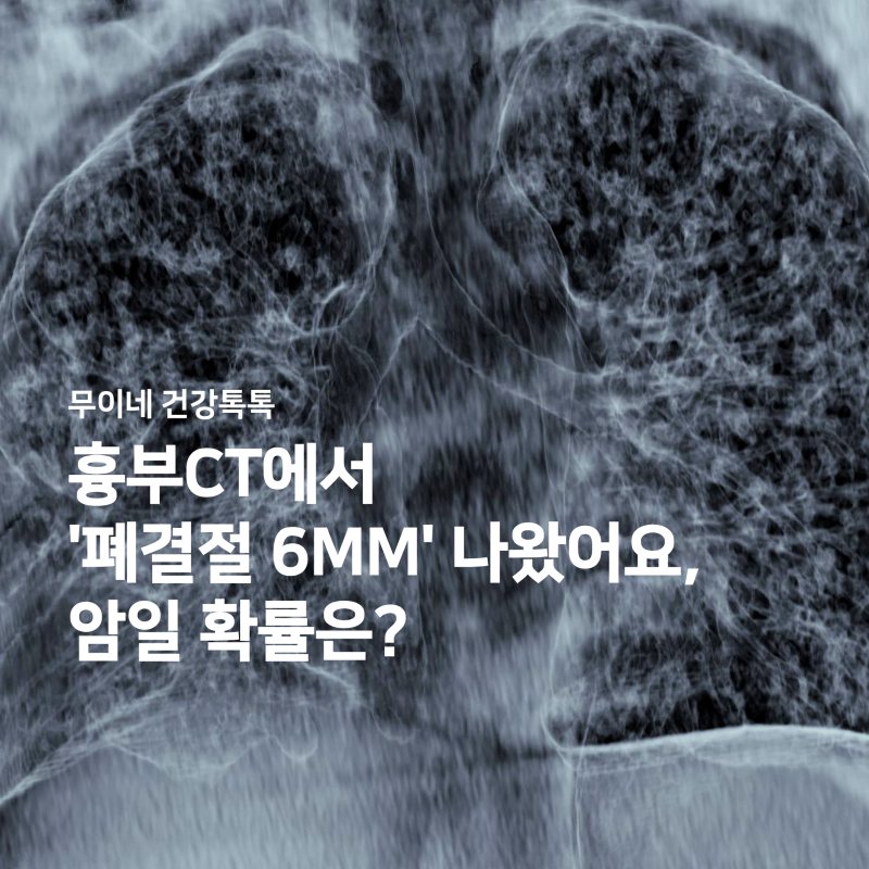 흉부CT에서 '폐결절 6mm' 나왔어요, 암일 확률과 추적관찰 주기 총정리