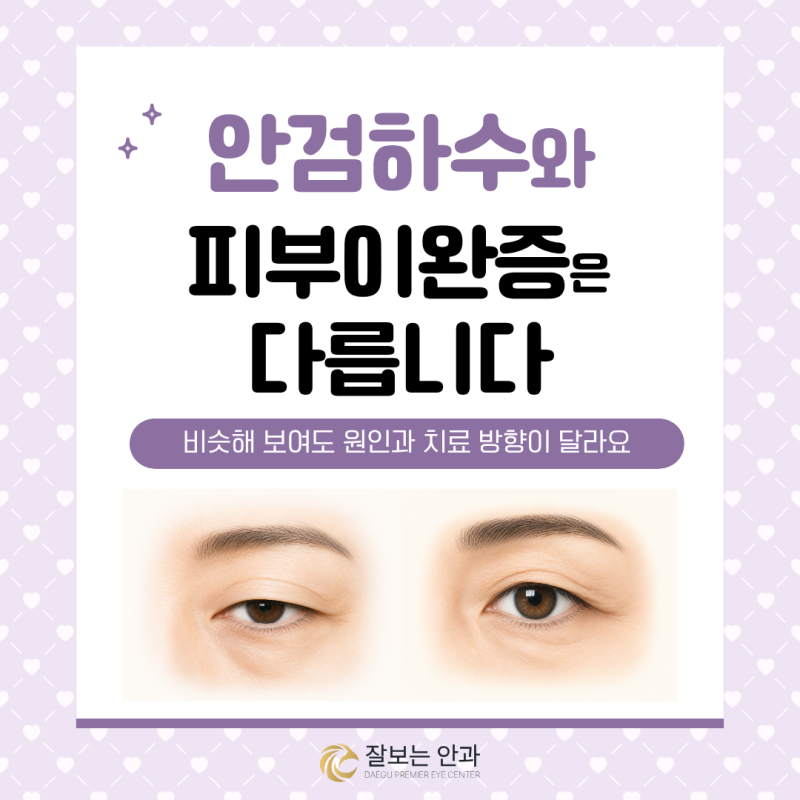 대구안검하수, 눈꺼풀 피부이완증과 어떻게 다를까요? | 잘보는안과