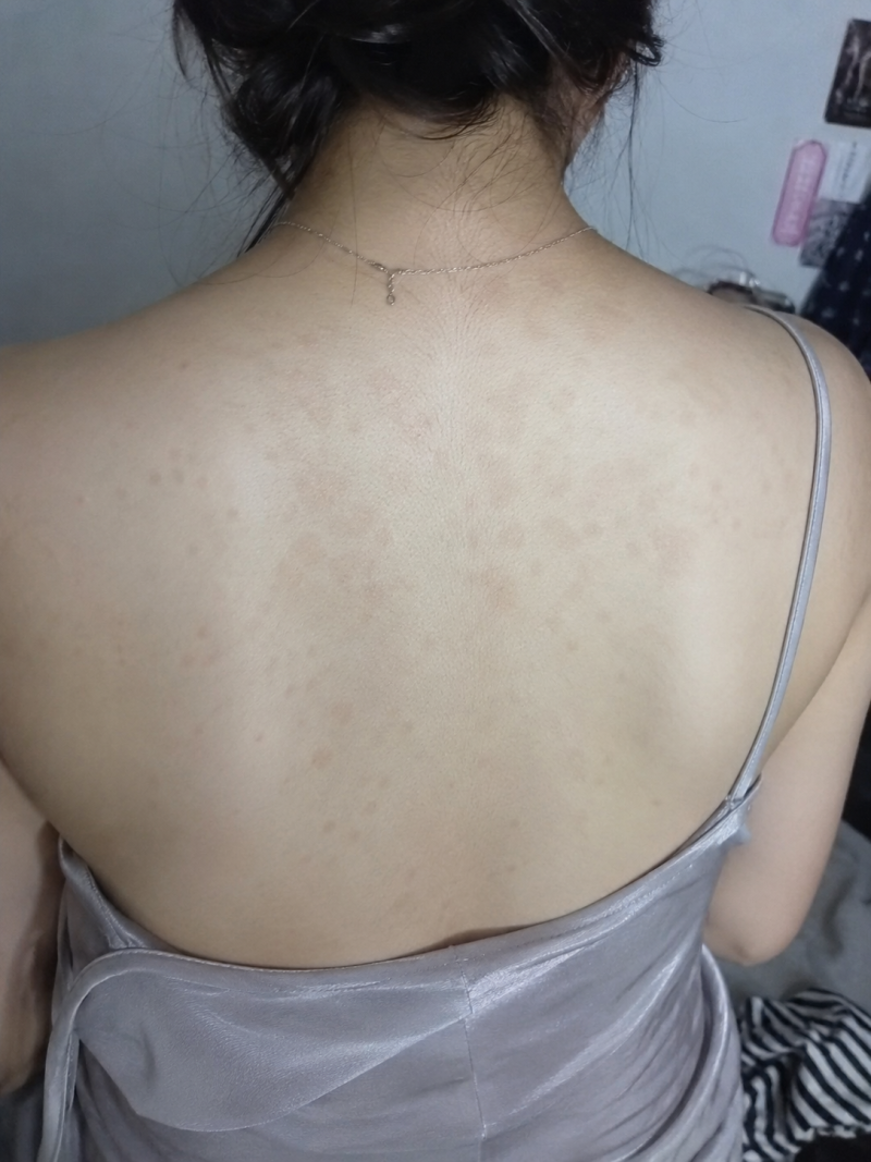 등 어루러기 왜 여름마다 반복될까? 말라세지아 관리법