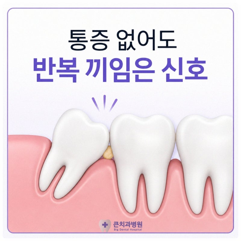 사랑니 발치, 통증은 없는데 음식물이 자주 낀다면?