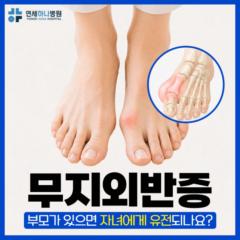 마전동정형외과 무지외반증유전, 부모가 있으면 반드시 생길까요?