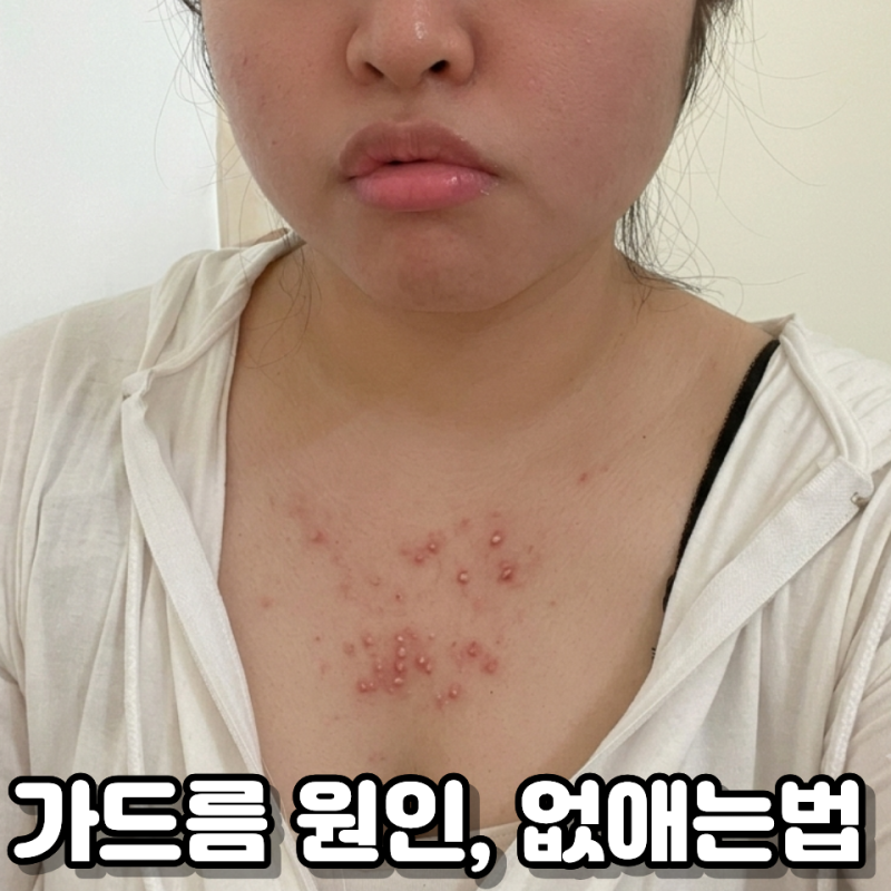 "더 이상 숨기지 마세요" 가드름 원인 없애는법 총정리