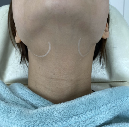 청주침샘보톡스, 무슨 짓을 해도 줄어들지 않는 이중턱 '침샘'이 원인일 수 있다?