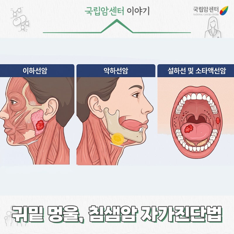 귀밑, 턱밑에 멍울이 만져진다면? 침샘암 증상부터 수술 후 합병증까지 I 국립암센터 갑상선....