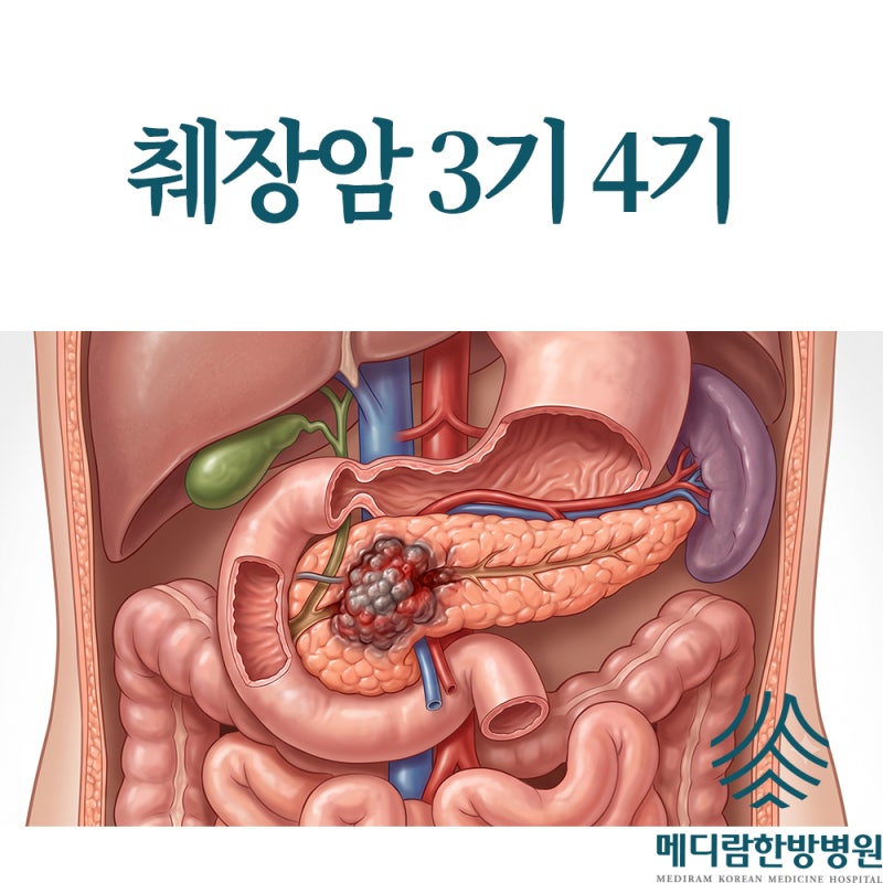췌장암 3기 4기 생존율 조금이라도 높이려면