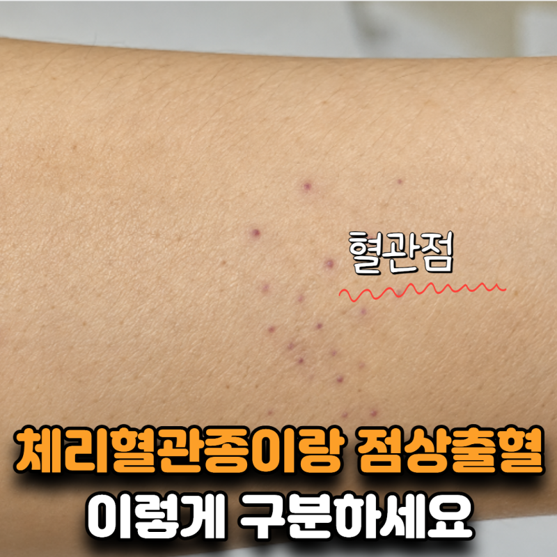 “빨간 점이 갑자기 많아졌어요” 체리혈관종과 점상출혈 구별법