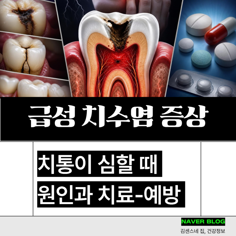 급성 치수염 증상 원인, 치통이 심할때 통증 치료 약, 예방법