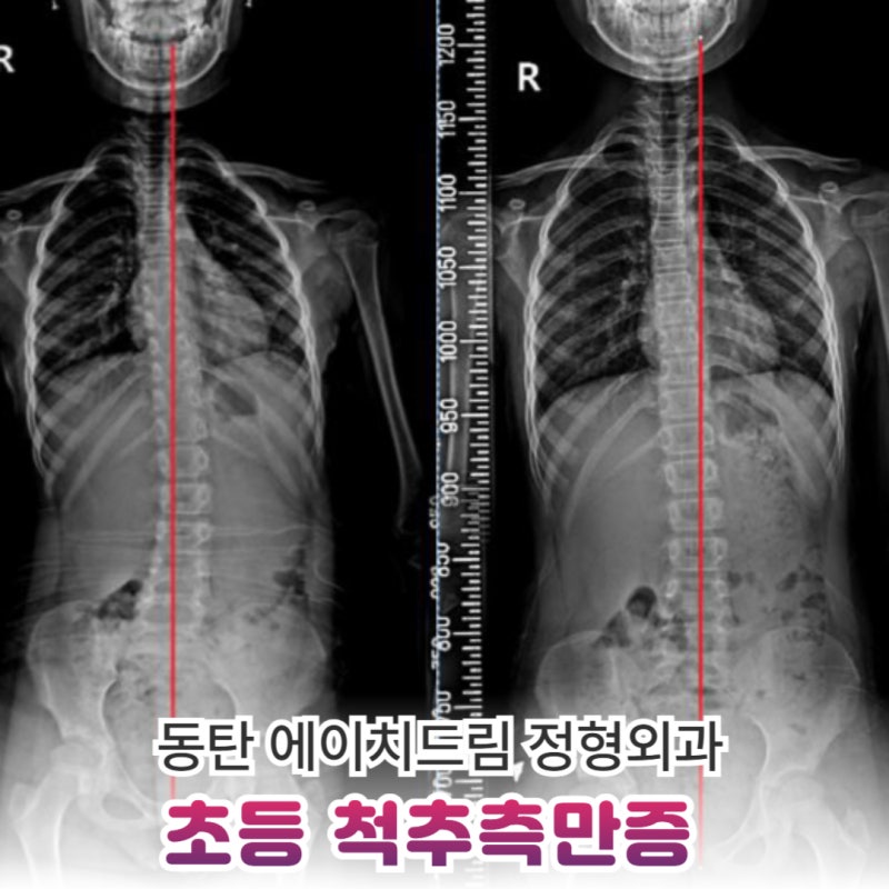 초등 척추측만증, 19년 정형외과가 말하는 확인 기준 2가지