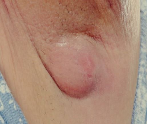 겨드랑이 멍울 치료, 병원, 수술, 초음파, 아픔, 조직검사, 고름