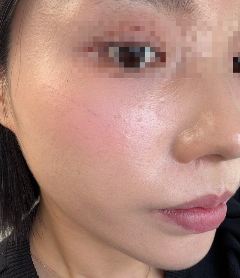 울산 편평사마귀 제거과정(1~7일차) 리얼후기 | 출산후 심해진 편사제거 대만족 | 편사제거 후....
