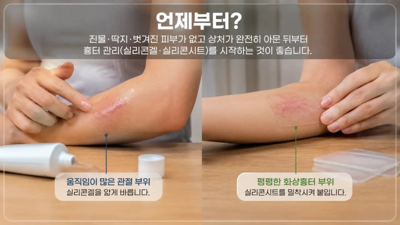 화상흉터 연고 언제부터? 딱지 떨어진 뒤가 중요한 이유