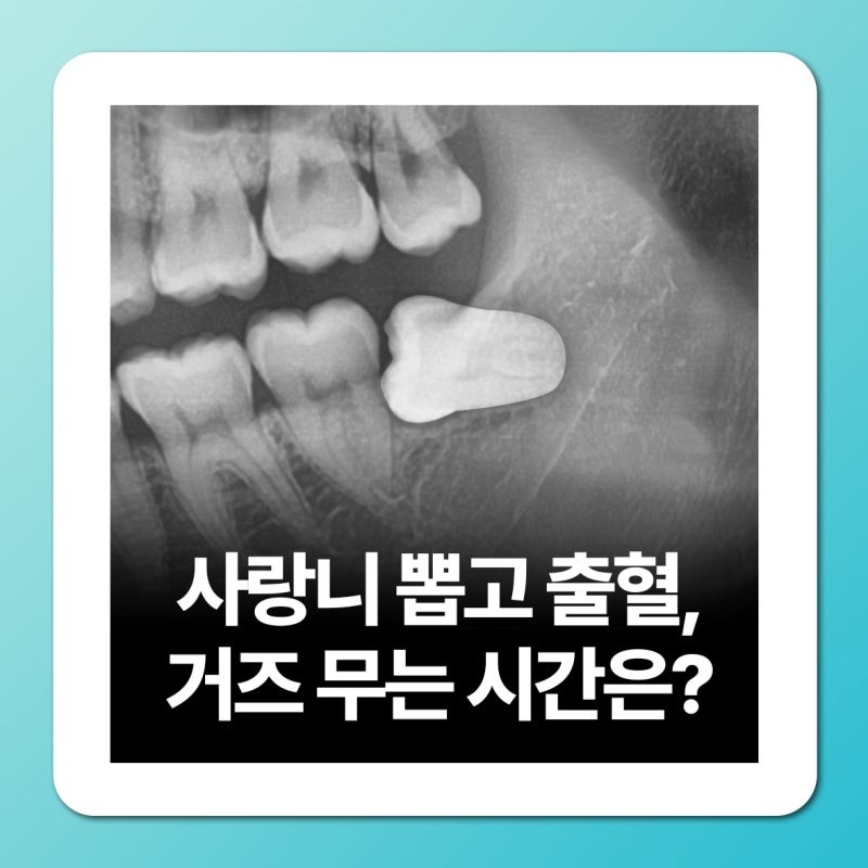 사랑니 뽑고 피 출혈 지혈, 거즈는 얼마나 물어야 할까?