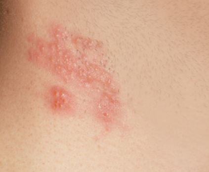 겨드랑이 물집 증상, 치료, 대처방법, 없애는법, 주의사항