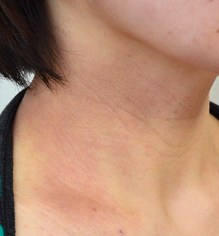 태선화란? 아토피 오래 앓으면 생기는 피부 변화, 직접 겪고 정리했어요