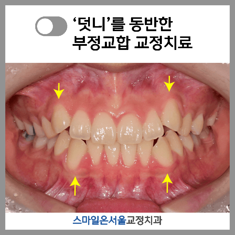덧니 교정 과정, 기간, 후기 총정리｜비발치 교정치료 가능할까?