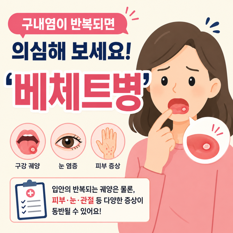 구내염이 반복되면 의심해 보세요! "베체트병(Behcet's disease)"