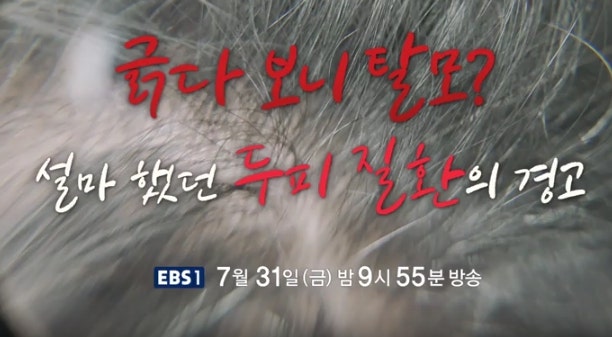 명의 피부과 이양원의사 병원 탈모 두피질환 지루피부염 원인 두피건선 차이점 치료법 모낭....