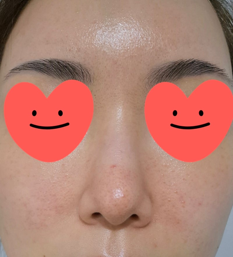 [병환일지] 내가 주사피부염 이라니 11 (수란트라 3개월 차 사용 후기 & 실비 청구 안되는 이유....