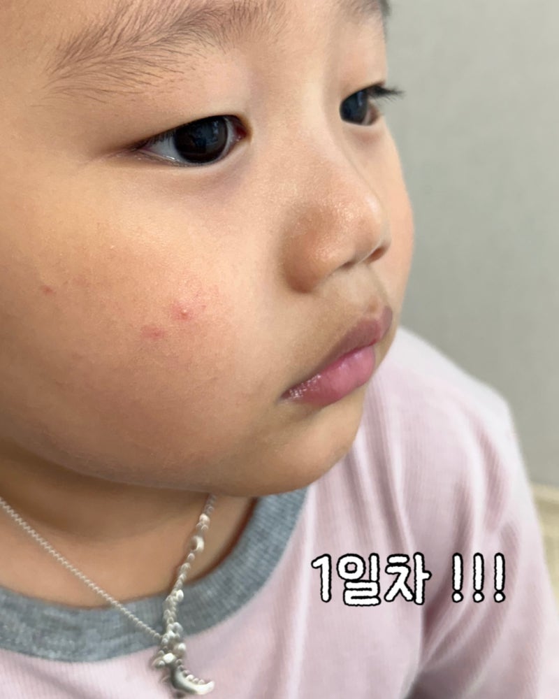 아이 모공각화증 뾰루지 트러블 추천템 내돈내산 !!
