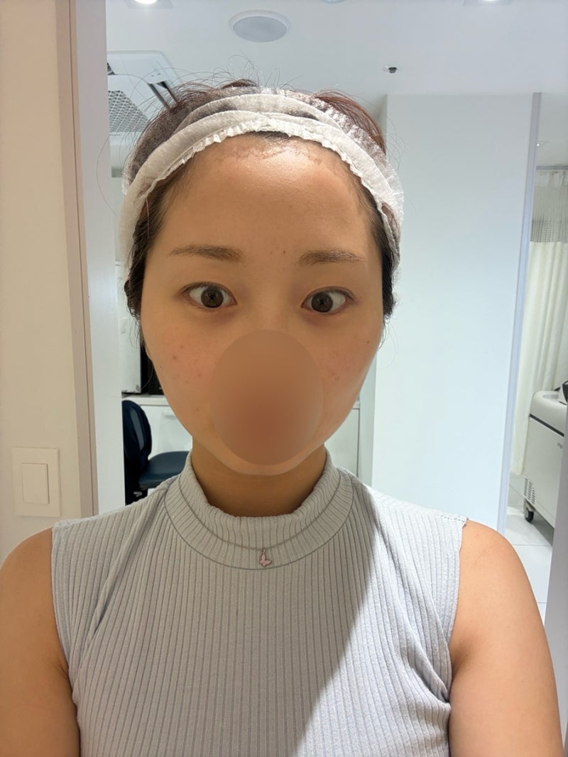 편평사마귀 무제한 제거 후기! 강남 HPV치료 성지 한의원