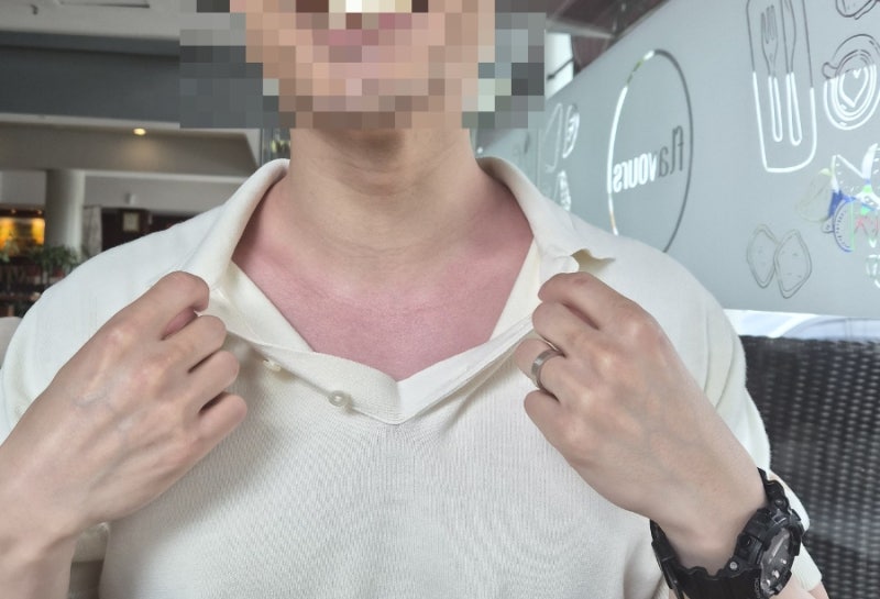 [햇빛 화상] 약국 화상 연고 총정리 (치료제·습윤밴드/부위별 케어)