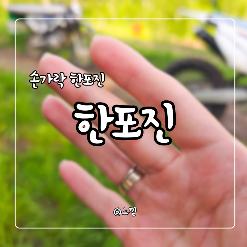 손바닥 손가락 한포진 증상 원인 치료