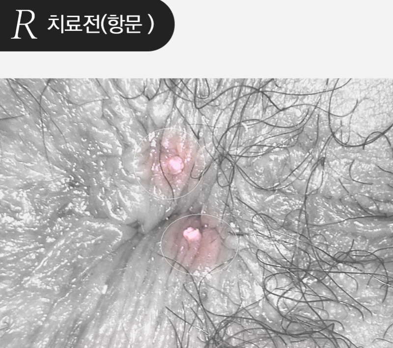 항문 곤지름 모양, 증상이 의심될 때 바로 병원 가야 하는 신호는?