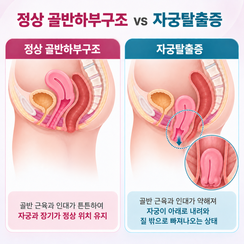 50대 부터 주의, 여성 자궁탈출증 수술의 종류와 방법, 천골질고정술(자궁거상술) SCP 설명