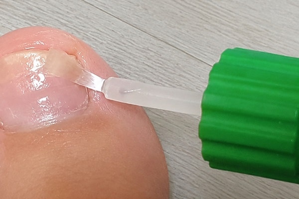 바르지오 무좀약 네일라카 울퉁불퉁 손발톱 관리 기록