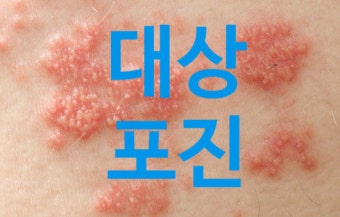 대상포진무료접종되나/노원구는무료,종로구는안돼?72시간골든타임지켜야한다!