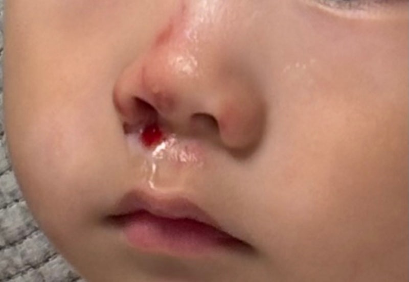 상처에 바르는 연고 후시딘/마데카솔/에스로반 차이 총정리 | 상처 종류별로 뭘 발라야 효과....