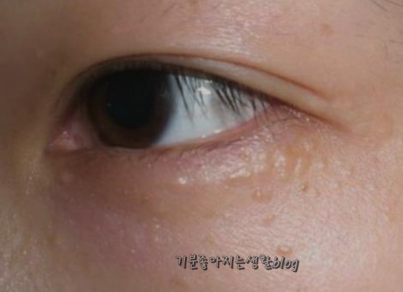 눈가 비립종 안과 제거 원인, 눈밑 오돌토돌 홈케어 꿀팁!