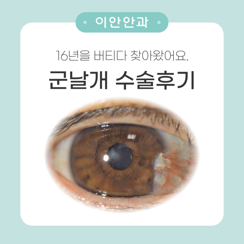 [이안안과] 재발없는 군날개, 익상편 수술 후기