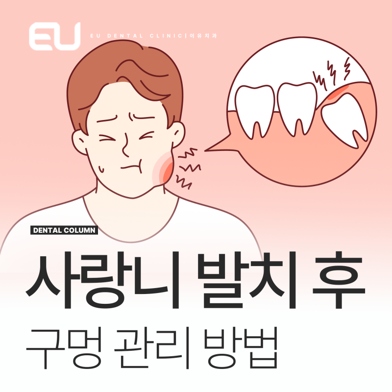 완전 매복사랑니 발치 후 구멍 관리 방법, 드라이소켓이란
