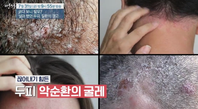 머리 가려움증 두피 염증 지루피부염 건선 탈모 머리카락이 안자라는 이유 (EBS 명의 피부과 ....