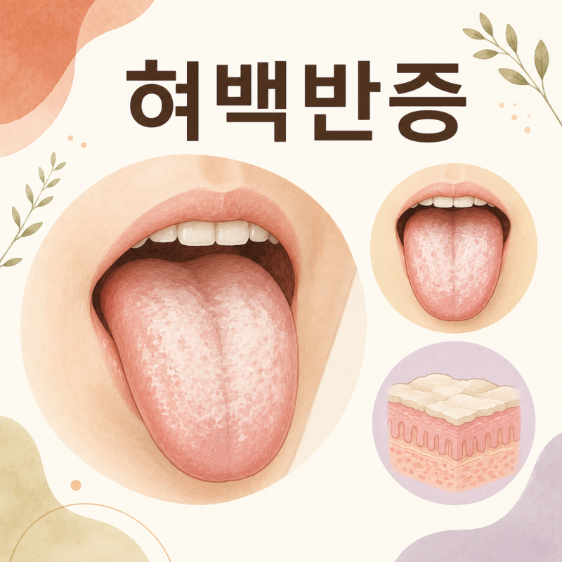 혀 하얀반점, 혀백반증 오래 지속되면 치과 가봐야 합니다