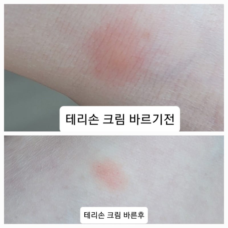 모기 물려 부었을 때 급처방! 심한 모기 알레르기 연고 추천 및 대처법(스키터 증후군)