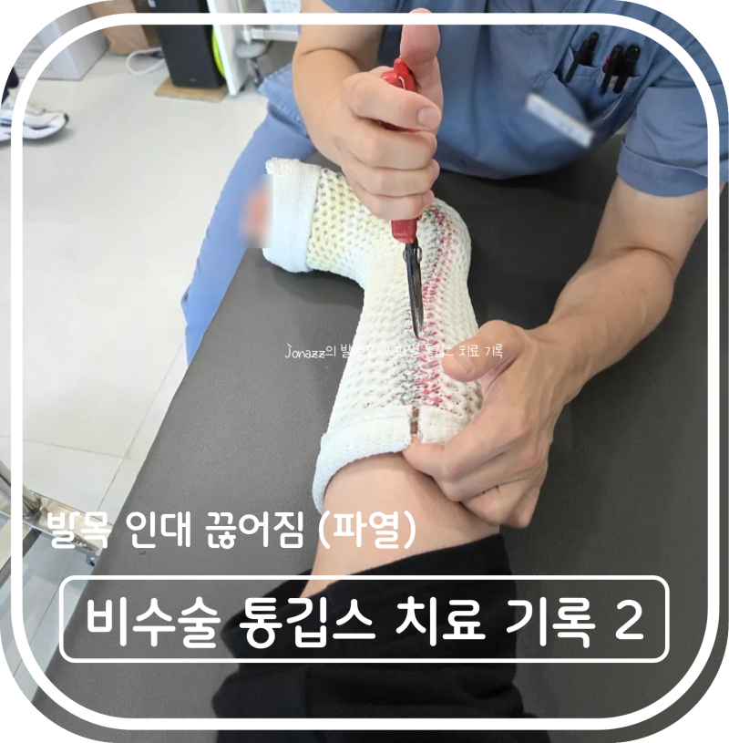 발목 인대 끊어짐 (파열) 비수술 통깁스 풀고 치료 기록