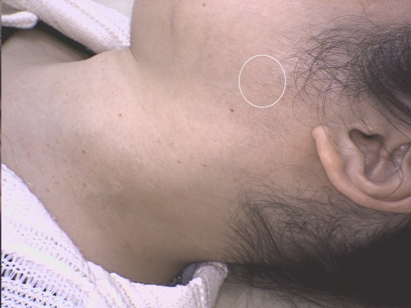 편평사마귀 제거 후 관리, 연고, 재생크림, 레이저, 면역치료