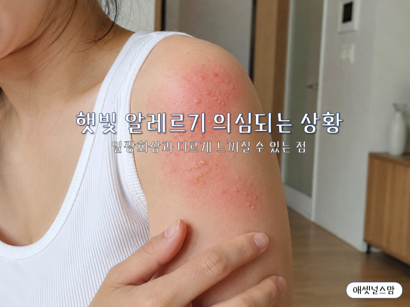햇빛 알레르기, 일광화상과 다른 여름 피부발진일까?