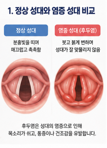후두염 증상과 초기증상, 쉰 목소리만 보면 놓칩니다