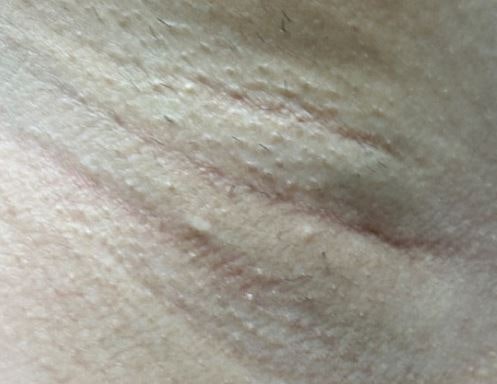 겨드랑이 모공 각화증 원인, 이유, 증상, 치료, 관리, 시술방법