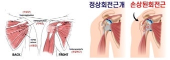 회전근개 및 이두박근 힘줄 파열 시 MSM 보충 필요