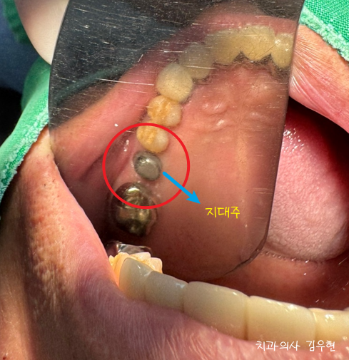 임플란트 시리즈 ② | 임플란트 2차 수술, 잇몸을 다시 여는 이유는? (지대주 연결)