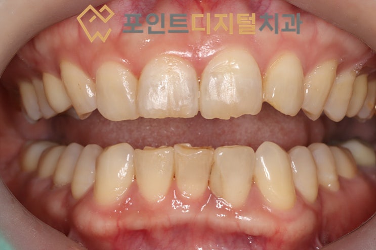 [불당 치아미백] 50대 환자분 A3.5에서 A1까지 톤업! (오스템 뷰티스 15 미백폭발코스 후기) / 천안 아산