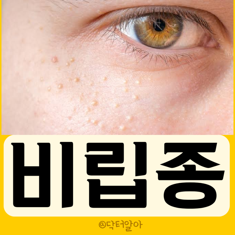 의사가 설명하는 비립종 정의 증상 원인 진단 제거 치료 예방