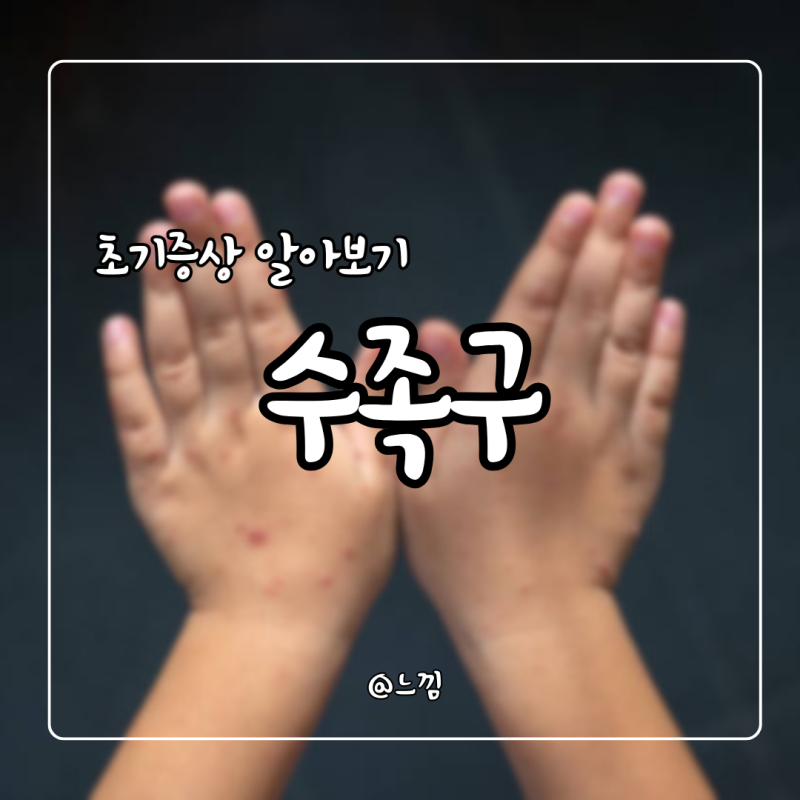 아기 수족구 초기증상 성인 전염 수포 잠복기